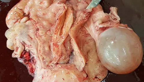 Follikelcyste Tilrettet2